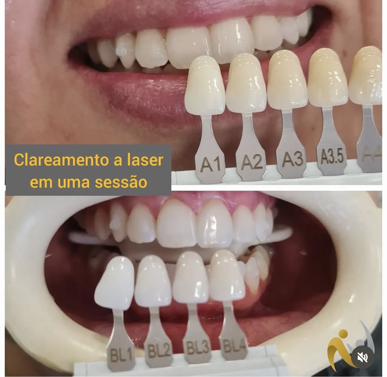 Clareamento dental híbrido (laser + auto aplicação)